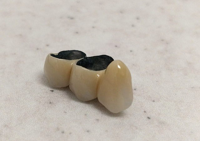 Metalokeramické fixní náhrady